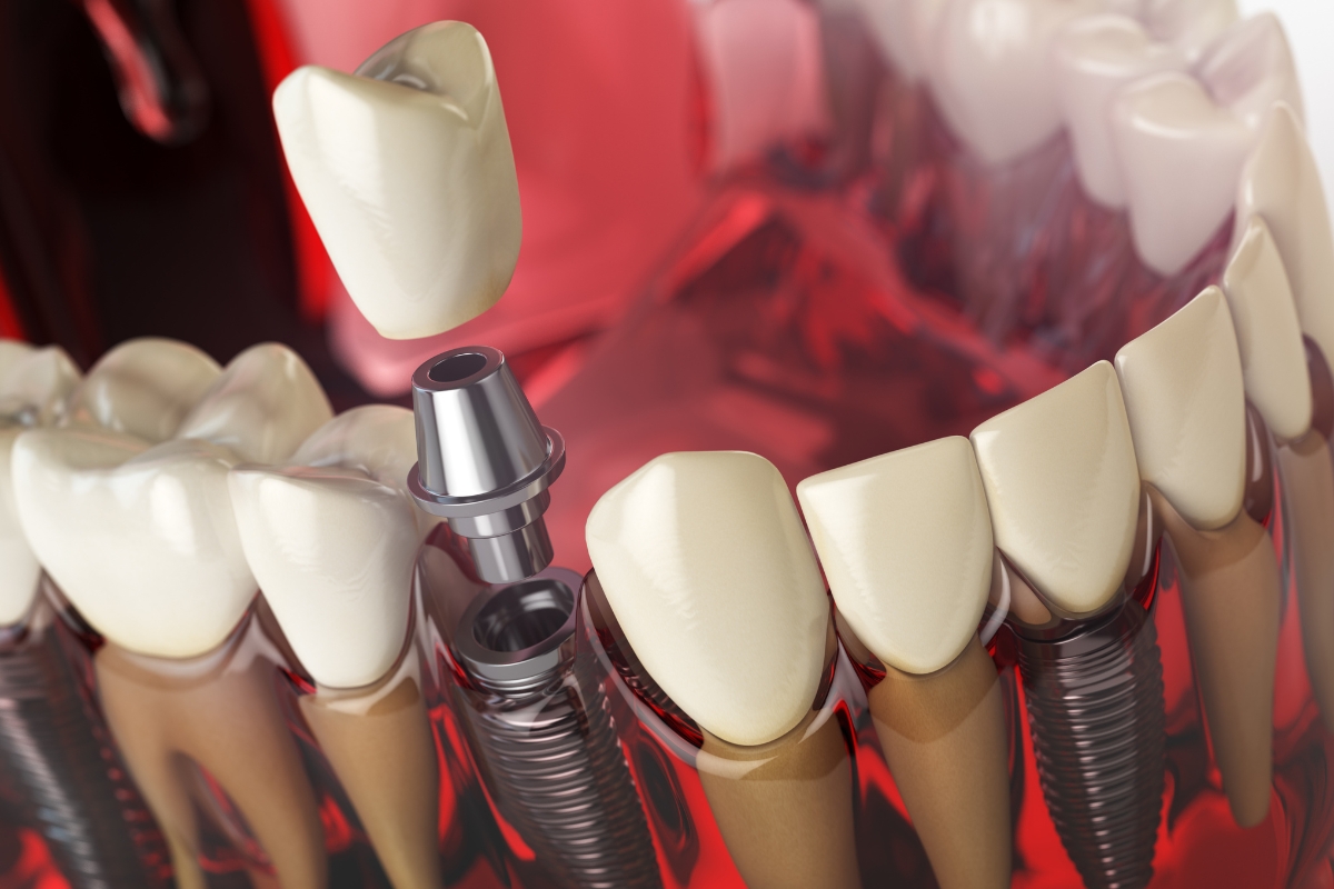 Advanced Dental Implants Austin