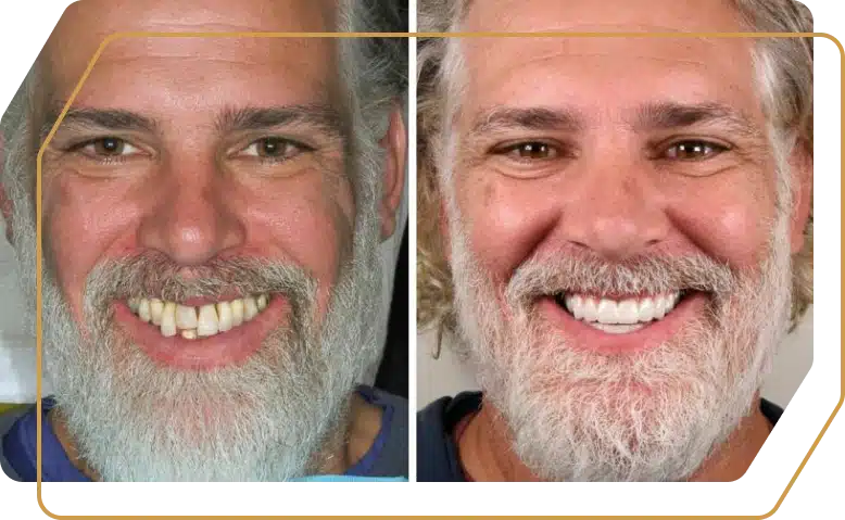$199 Off Dental Implants!